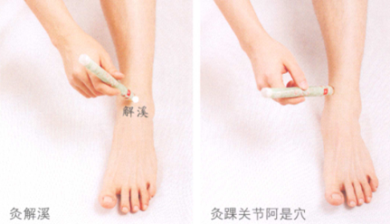 踝關(guān)節(jié)扭傷艾灸