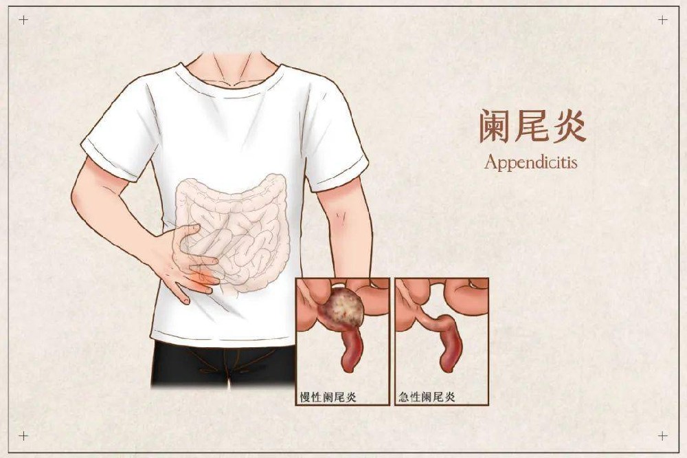 闌尾炎不能吃什么食物？