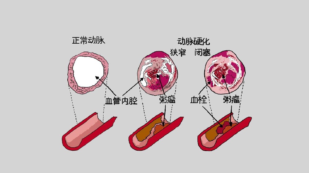 動脈硬化應(yīng)該注意哪些飲食戒律？