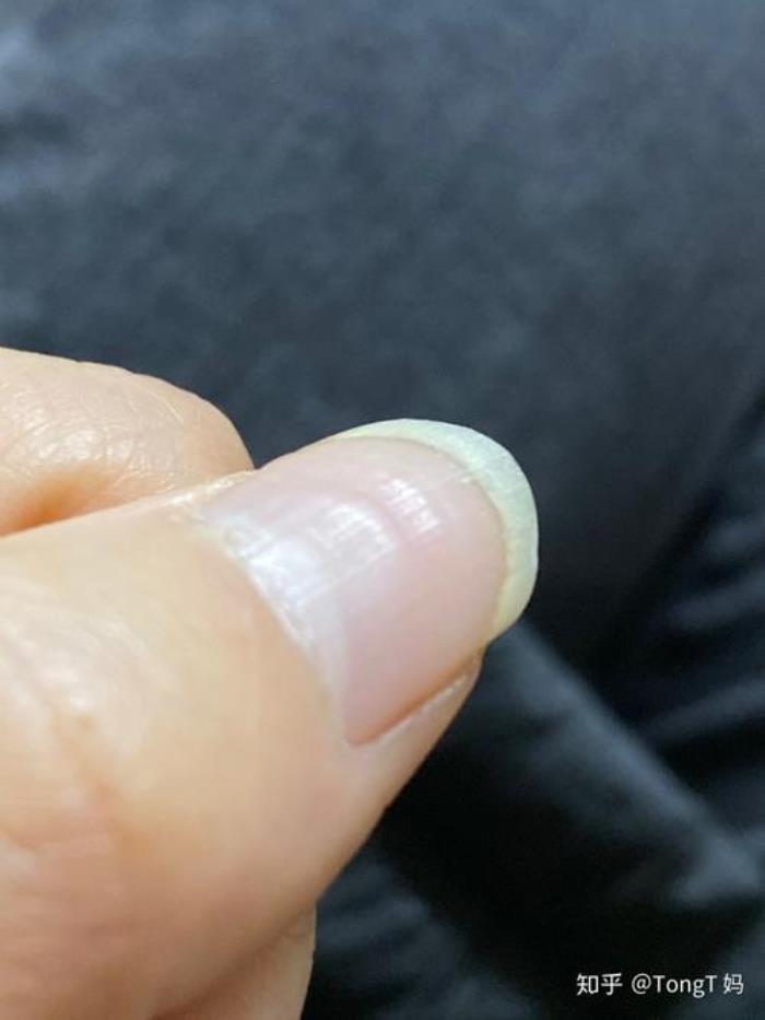大拇指橫紋多代表什么 大拇指有很深的橫紋