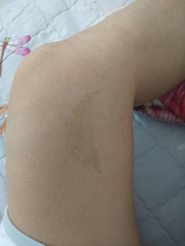 大腿上有胎記的女人 大腿上有胎記好不好
