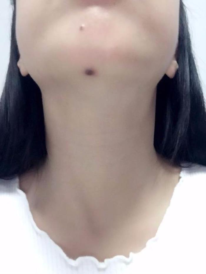 下巴有痣對自身有何影響嗎 長在下巴的痣代表什么