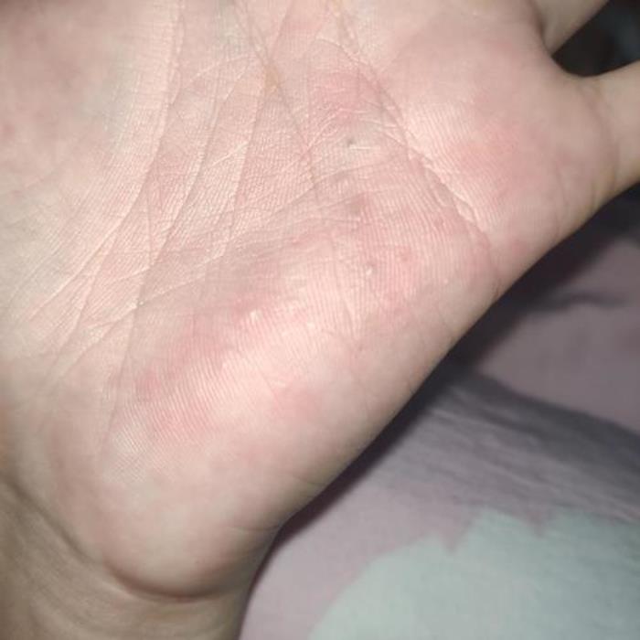 左手心癢是發(fā)財(cái)預(yù)兆嗎 左手發(fā)癢是什么征兆