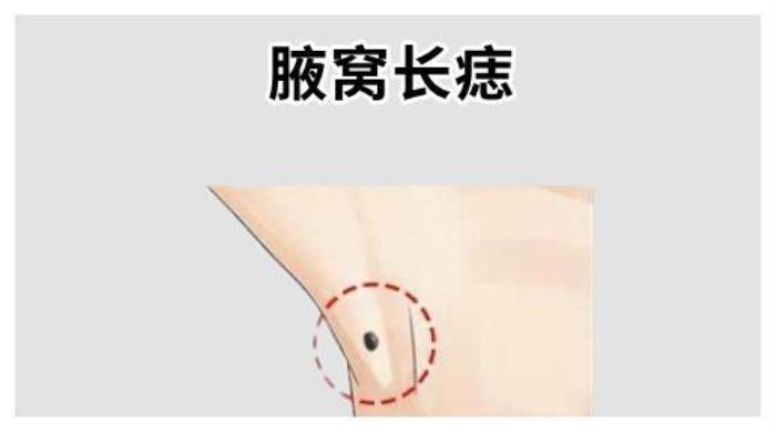 身上痣的吉兇影響人的財(cái)運(yùn)嗎 吉痣點(diǎn)掉了會(huì)沒(méi)福氣嗎