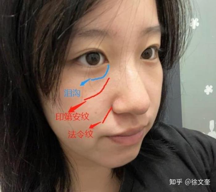 有淚溝的人什么命運(yùn) 眼下凹陷和淚溝大怎么辦