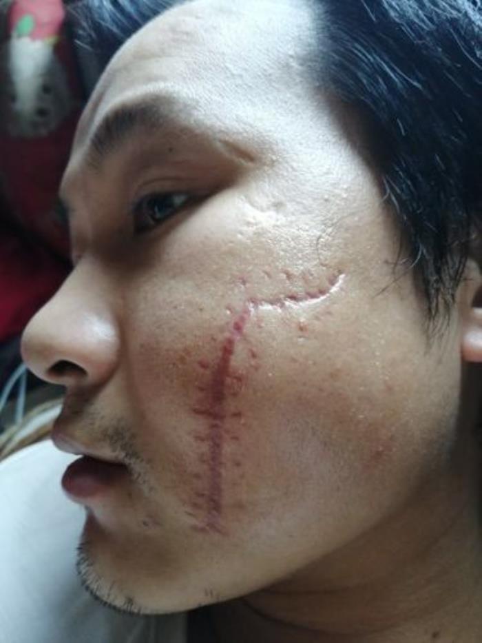 臉上有疤痕代表什么命運(yùn) 臉上有疤的女人命好嗎