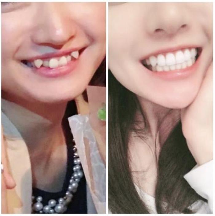 有虎牙的女人面相 女人兩邊有虎牙好嗎