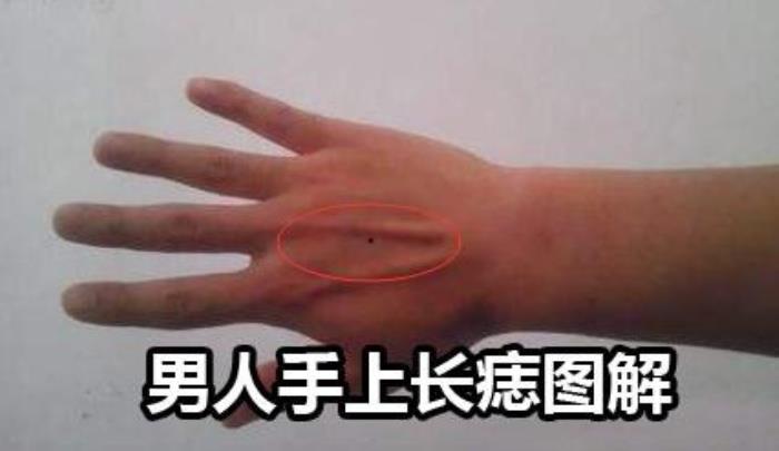 男人右手背長(zhǎng)痣 男人的右手背長(zhǎng)痣：