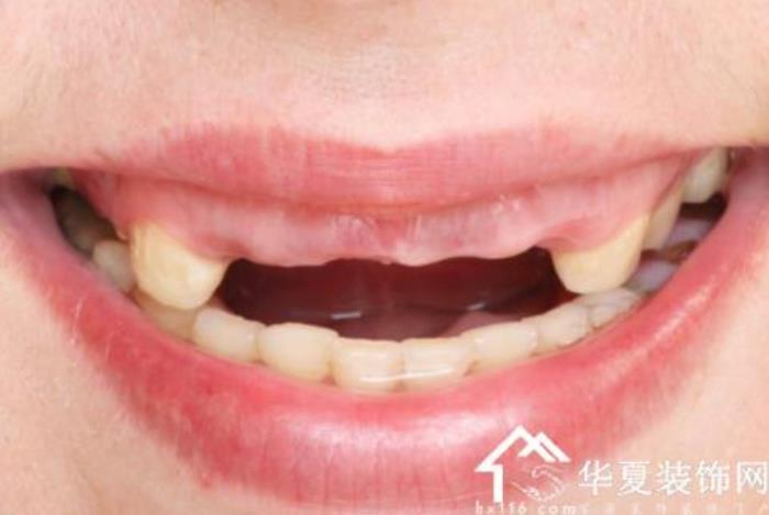 夢(mèng)見掉牙親人離世的真實(shí)案例 上牙代表父母下牙代表兒女