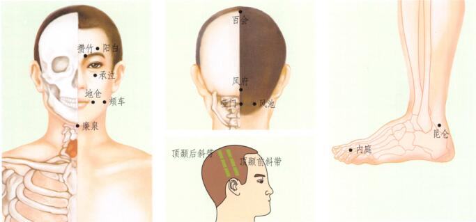 中風后遺癥刮痧