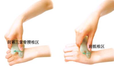 腰椎間盤突出刮痧