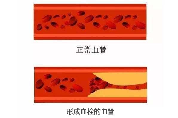 正常血管 與有血栓血管對比